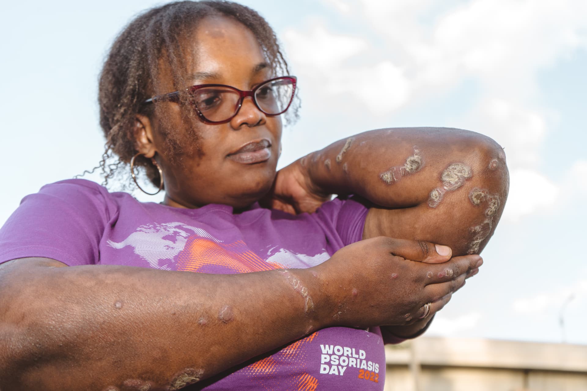 Patient with psoriasis