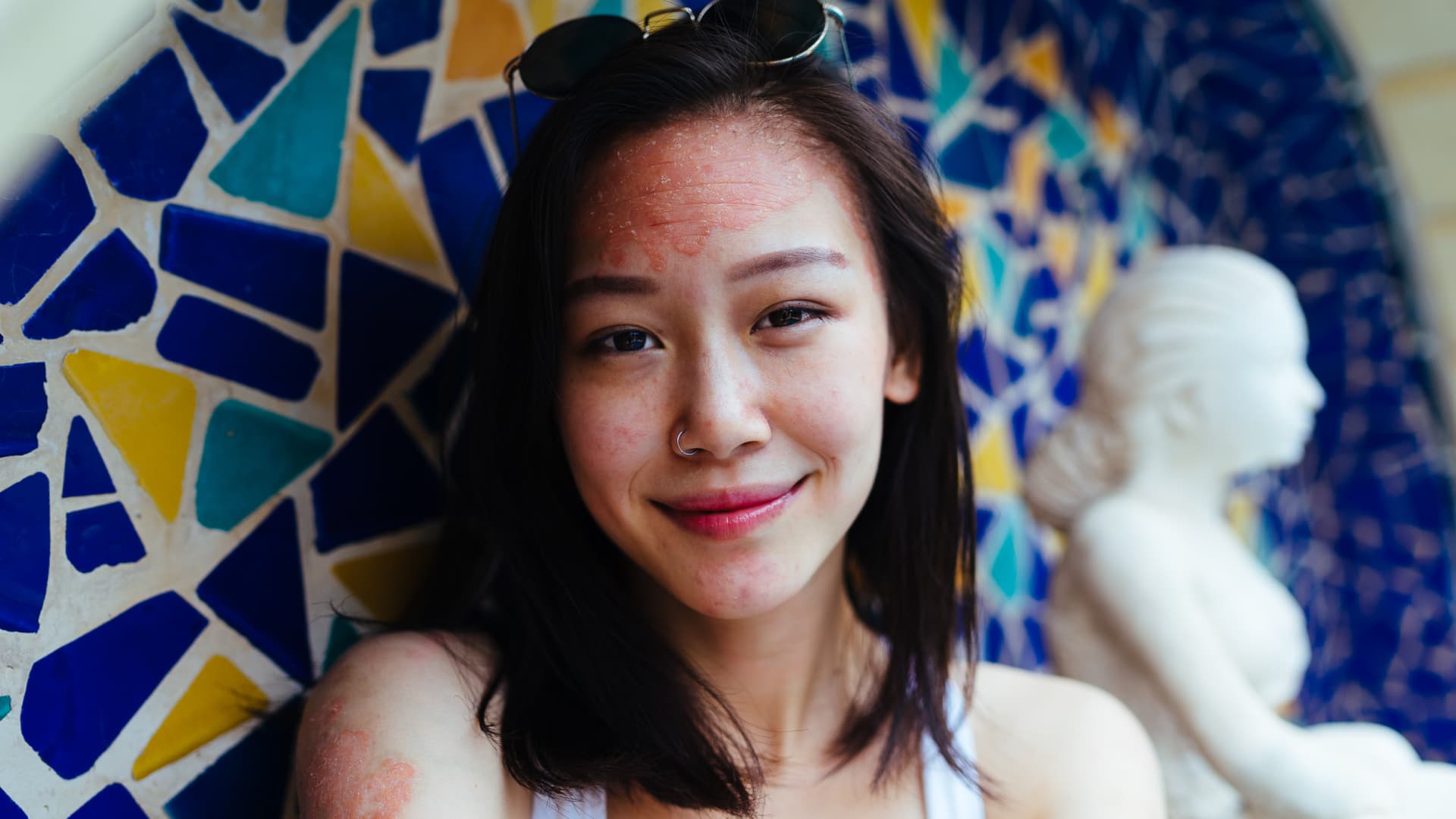 Considering quality of life when classifying psoriasis severity