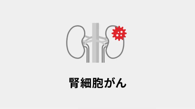 腎細胞がん