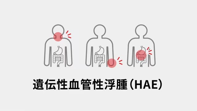 遺伝性血管性浮腫（HAE）