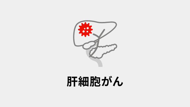 肝細胞がん