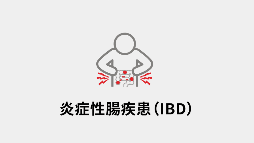 炎症性腸疾患（IBD）