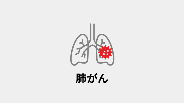 肺がん