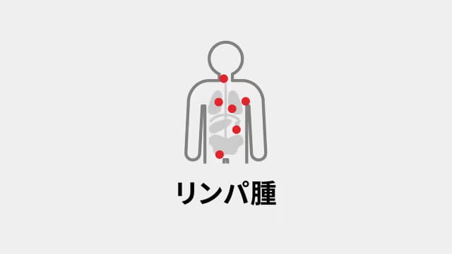 リンパ腫