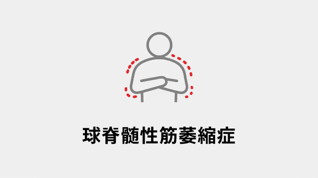 球脊髄性筋萎縮症