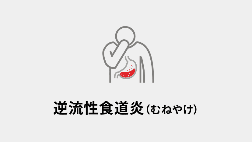 逆流性食道炎（むねやけ）