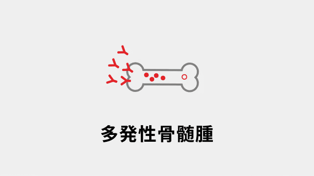 多発性骨髄腫
